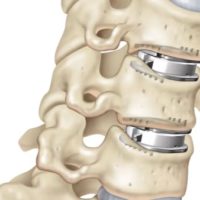 prothese discale cervicale remboursement prothese discale avis chirurgie du rachis espace francilien du rachis clinique du rachis versailles paris