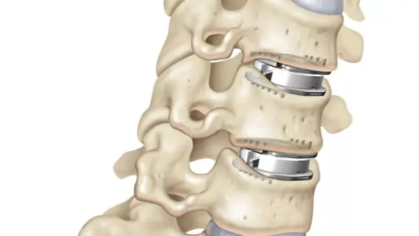 prothese discale cervicale remboursement prothese discale avis chirurgie du rachis espace francilien du rachis clinique du rachis versailles paris