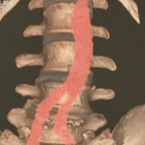 prothese discale lombaire prix chirurgie prothese discale lombaire reeducation chirurgie du rachis espace francilien du rachis clinique du rachis versailles paris 4
