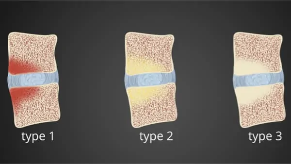 prothese discale lombaire prix chirurgie prothese discale lombaire reeducation chirurgie du rachis espace francilien du rachis clinique du rachis versailles paris 6