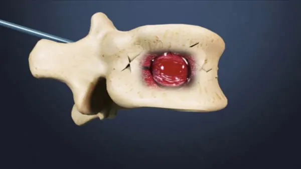 reeducation apres cimentoplastie cancer cimentoplastie lombaire chirurgie du rachis espace francilien du rachis clinique du rachis versailles paris 1