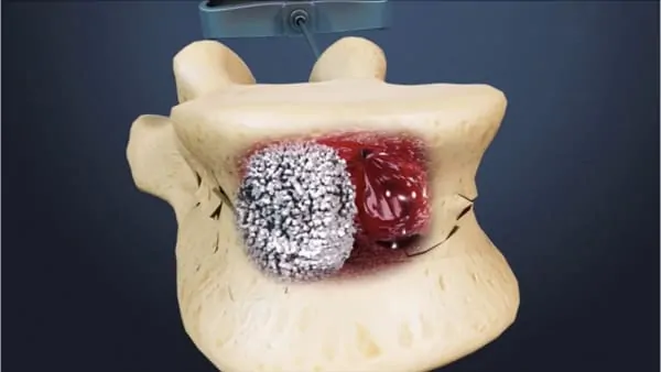 reeducation apres cimentoplastie cancer cimentoplastie lombaire chirurgie du rachis espace francilien du rachis clinique du rachis versailles paris 2