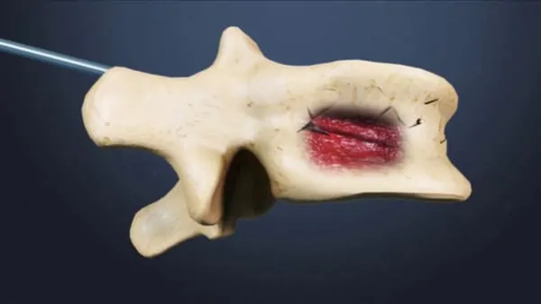 reeducation apres cimentoplastie cancer cimentoplastie lombaire chirurgie du rachis espace francilien du rachis clinique du rachis versailles paris 3