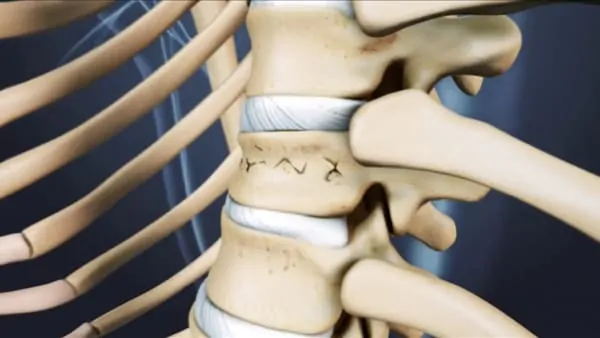 reeducation apres cimentoplastie cancer cimentoplastie lombaire chirurgie du rachis espace francilien du rachis clinique du rachis versailles paris 4