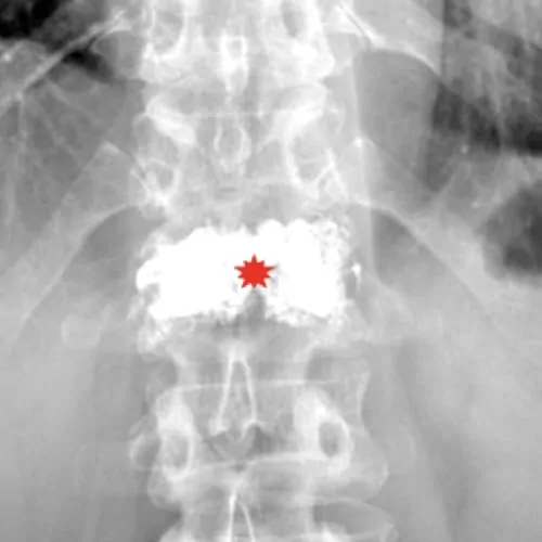 reeducation apres cimentoplastie cancer cimentoplastie lombaire chirurgie du rachis espace francilien du rachis clinique du rachis versailles paris 5