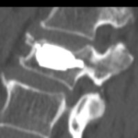 reeducation apres cimentoplastie cancer cimentoplastie lombaire chirurgie du rachis espace francilien du rachis clinique du rachis versailles paris 6