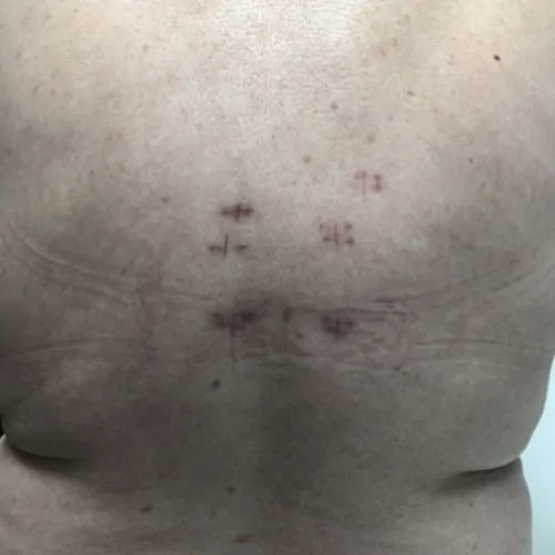 reeducation apres cimentoplastie cancer cimentoplastie lombaire chirurgie du rachis espace francilien du rachis clinique du rachis versailles paris 7