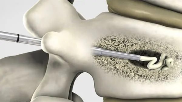 reeducation apres cimentoplastie cancer cimentoplastie lombaire chirurgie du rachis espace francilien du rachis clinique du rachis versailles paris reeducation apres cimentoplastie cancer cimentoplastie lombaire chirurgie du rachis espace francilien du rachis clinique du rachis versailles paris