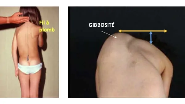 scoliose ado probleme de dos la scoliose lombaire scoliose definition scoliose traitement espace francilien du rachis clinique du rachis versailles paris 3
