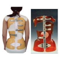 scoliose ado probleme de dos la scoliose lombaire scoliose definition scoliose traitement espace francilien du rachis clinique du rachis versailles paris 7