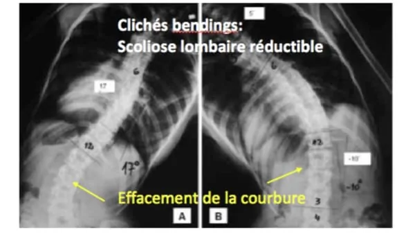scoliose ado probleme de dos la scoliose lombaire scoliose definition scoliose traitement espace francilien du rachis clinique du rachis versailles paris 9