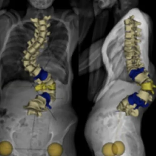 scoliose lombaire la scoliose adulte operation scoliose adulte traitement scoliose adulte que faire espace francilien du rachis clinique du rachis versailles paris 10