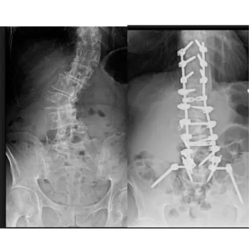 scoliose lombaire la scoliose adulte operation scoliose adulte traitement scoliose adulte que faire espace francilien du rachis clinique du rachis versailles paris 12