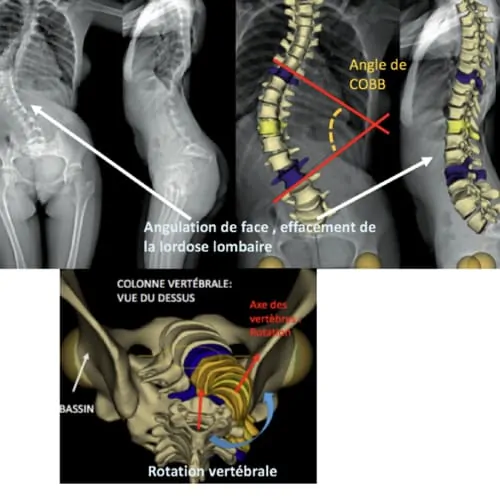 scoliose lombaire la scoliose adulte operation scoliose adulte traitement scoliose adulte que faire espace francilien du rachis clinique du rachis versailles paris 2