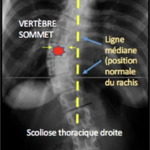 scoliose lombaire la scoliose adulte operation scoliose adulte traitement scoliose adulte que faire espace francilien du rachis clinique du rachis versailles paris 3
