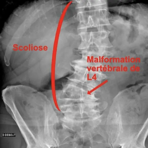 scoliose lombaire la scoliose adulte operation scoliose adulte traitement scoliose adulte que faire espace francilien du rachis clinique du rachis versailles paris 4