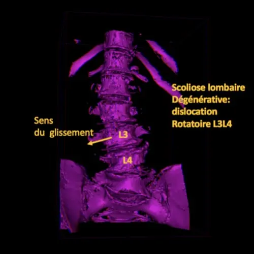 scoliose lombaire la scoliose adulte operation scoliose adulte traitement scoliose adulte que faire espace francilien du rachis clinique du rachis versailles paris 5