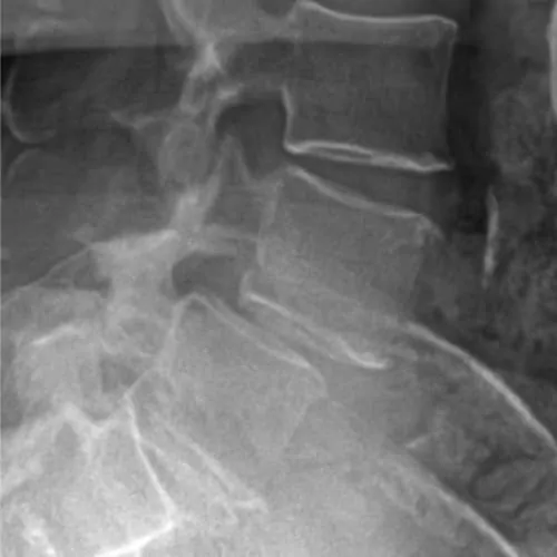 spondylolisthesis lombaire definition spondylolisthesis traitement spondylolisthesis grade 1 spondylolisthesis operation espace francilien du rachis clinique du rachis versailles paris 5
