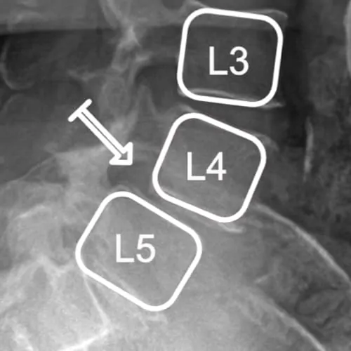 spondylolisthesis lombaire definition spondylolisthesis traitement spondylolisthesis grade 1 spondylolisthesis operation espace francilien du rachis clinique du rachis versailles paris 6