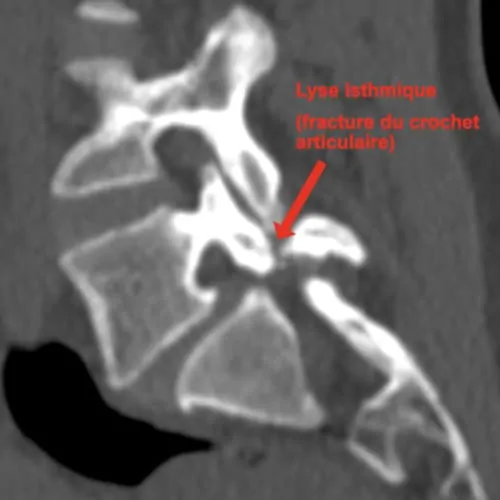 spondylolisthesis lombaire definition spondylolisthesis traitement spondylolisthesis grade 1 spondylolisthesis operation espace francilien du rachis clinique du rachis versailles paris 7