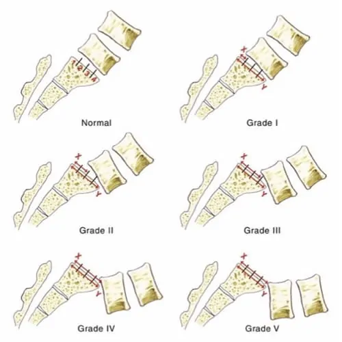 spondylolisthesis lombaire definition spondylolisthesis traitement spondylolisthesis grade 1 spondylolisthesis operation espace francilien du rachis clinique du rachis versailles paris 8