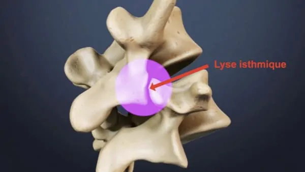spondylolisthesis lombaire definition spondylolisthesis traitement spondylolisthesis grade 1 spondylolisthesis operation espace francilien du rachis clinique du rachis versailles paris