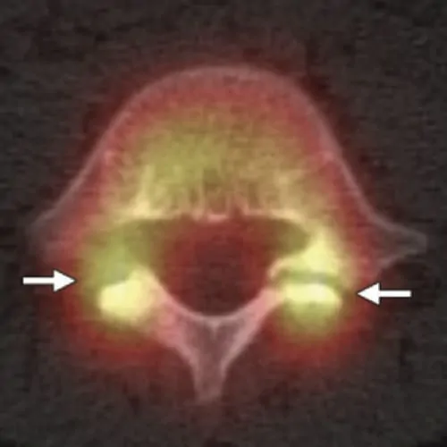 spondylolisthesis par lyse isthmique bilaterale spondylolisthesis traitement espace francilien du rachis clinique du rachis versailles paris 2