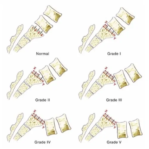 spondylolisthesis par lyse isthmique bilaterale spondylolisthesis traitement espace francilien du rachis clinique du rachis versailles paris 4