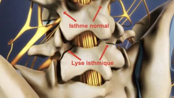 spondylolisthesis par lyse isthmique bilaterale spondylolisthesis traitement espace francilien du rachis clinique du rachis versailles paris spondylolisthesis par lyse isthmique bilaterale spondylolisthesis traitement espace francilien du rachis clinique du rachis versailles paris