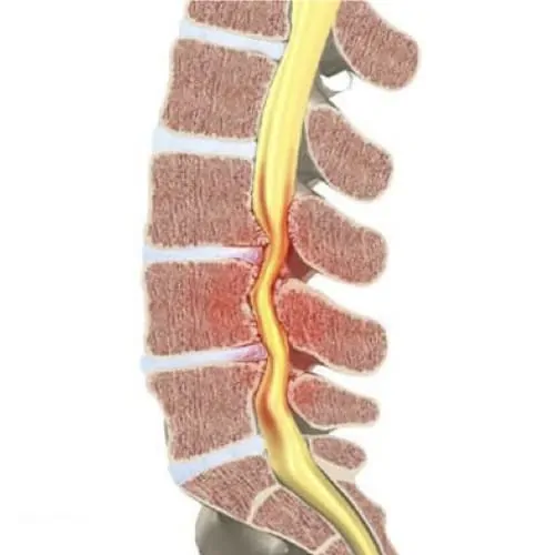 stenose lombaire severe stenose lombaire exercices stenose definition mal de dos lombaire espace francilien du rachis clinique du rachis versailles paris 1