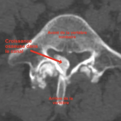 stenose lombaire severe stenose lombaire exercices stenose definition mal de dos lombaire espace francilien du rachis clinique du rachis versailles paris 2