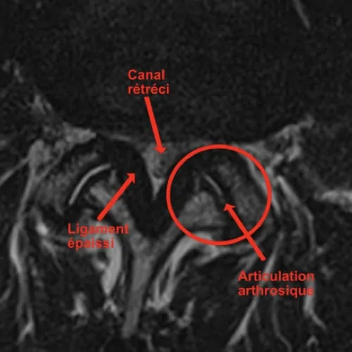 stenose lombaire severe stenose lombaire exercices stenose definition mal de dos lombaire espace francilien du rachis clinique du rachis versailles paris 3