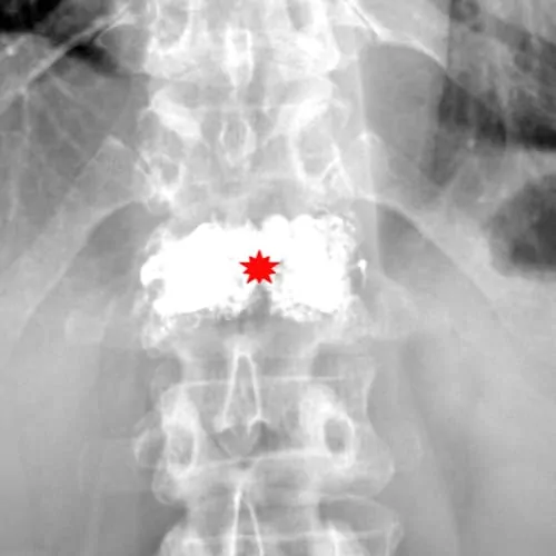 tassement vertebral traitement kine tassement de vertebre traitement tassement vertebral symptomes espace francilien du rachis clinique du rachis versailles paris 1
