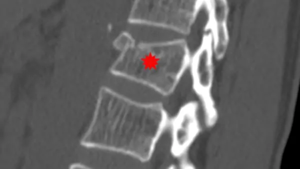 tassement vertebral traitement kine tassement de vertebre traitement tassement vertebral symptomes espace francilien du rachis clinique du rachis versailles paris 4