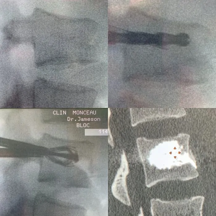 correction de tassement de vertebre par technique spinejack stryker espace francilien du rachis