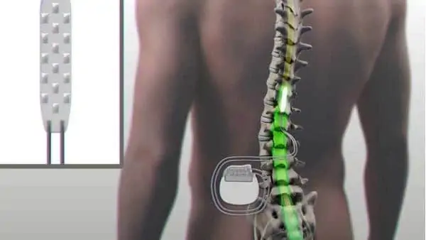 boitier de stimulation medullaire avec implantation electrodes espace francilien du rachis docteur jameson docteur lamerain
