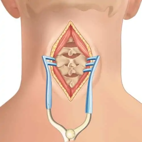 abord voie posterieure laminoplastie voie posterieure espace francilien rachis chirurgien specialiste dos paris dr jameson dr lamerain