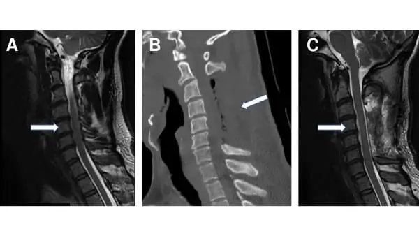 compression moelle epiniere laminectomie cervicale espace francilien rachis chirurgien specialiste dos paris dr jameson dr lamerain