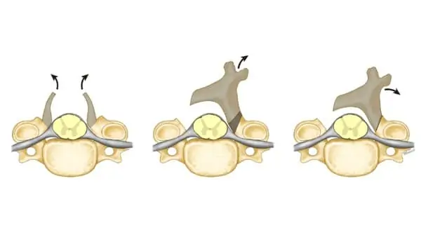 laminoplastie paris laminoplastie cervicale espace francilien rachis chirurgien specialiste dos paris dr jameson dr lamerain laminoplastie paris laminoplastie cervicale espace francilien rachis chirurgien specialiste dos paris dr jameson dr lamerain