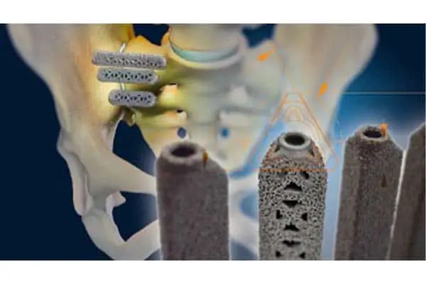 implants ifuse si bone operation sacro iliaque espace francilien rachis chirurgien specialiste dos colonne vertebrale paris dr jameson dr lamerain medecin de la douleur dr hayon dr labourdette paris
