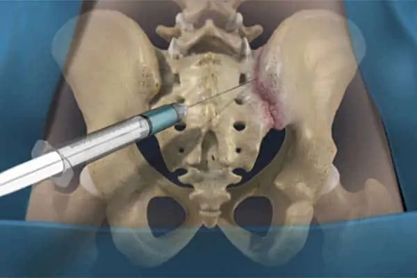 infiltration sacro iliaque espace francilien rachis chirurgien specialiste dos colonne vertebrale paris dr jameson dr lamerain medecin de la douleur dr hayon dr labourdette paris