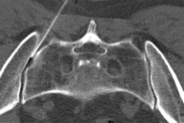 inflammation sacro iliaque cause espace francilien rachis chirurgien specialiste dos colonne vertebrale paris dr jameson dr lamerain medecin de la douleur dr hayon dr labourdette paris