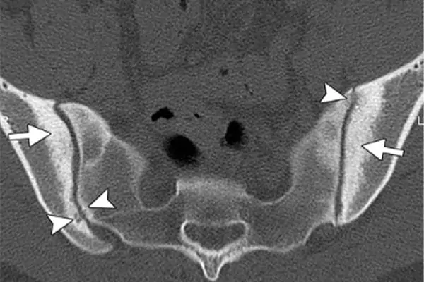 irm radiographie du bassin articulation sacro iliaque anatomie espace francilien rachis chirurgien specialiste dos paris dr jameson dr lamerain medecin de la douleur dr hayon dr labourdette paris