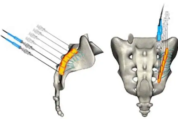 operation sacro iliaque espace francilien rachis chirurgien specialiste dos colonne vertebrale paris dr jameson dr lamerain medecin de la douleur dr hayon dr labourdette paris
