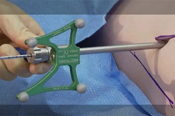operation sacrum douleur coccyx espace francilien rachis chirurgien specialiste dos colonne vertebrale paris dr jameson dr lamerain medecin de la douleur dr hayon dr labourdette paris