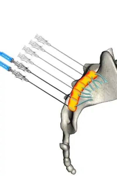 sacro iliaque neurolyse posterieure espace francilien rachis chirurgien specialiste dos colonne vertebrale paris dr jameson dr lamerain medecin de la douleur dr hayon dr labourdette