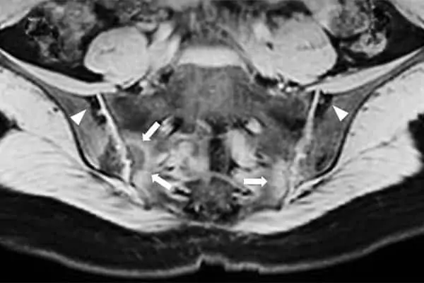 sacro iliaques inflammation espace francilien rachis chirurgien specialiste dos colonne vertebrale paris dr jameson dr lamerain medecin de la douleur dr hayon dr labourdette paris