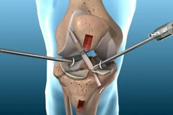 arthroscopie du genou chirurgie du rachis lombaire espace francilien du rachis clinique du rachis versailles paris