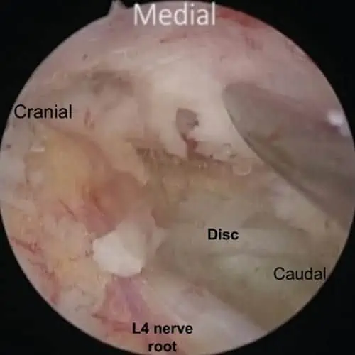 endoscopie hernie discale chirurgie du rachis espace francilien du rachis clinique du rachis versailles paris