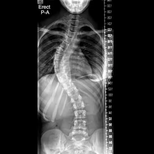 radio scoliose lombaire operation chirurgie du rachis espace francilien du rachis clinique du rachis versailles paris
